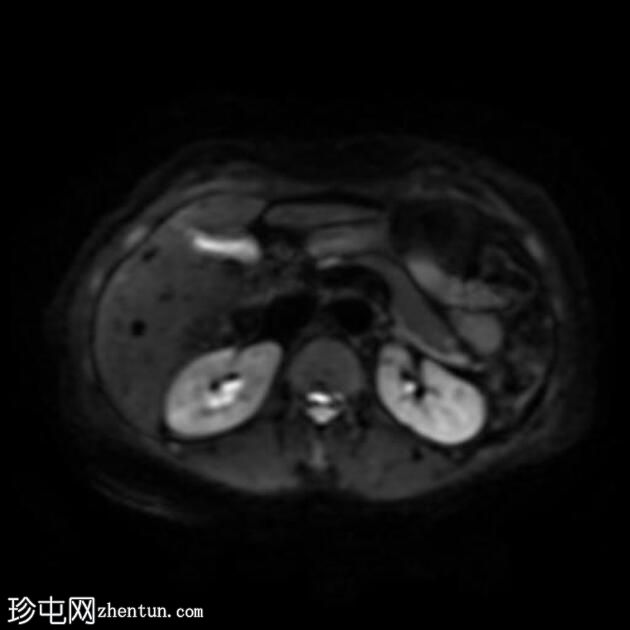 自身免疫性胰腺炎