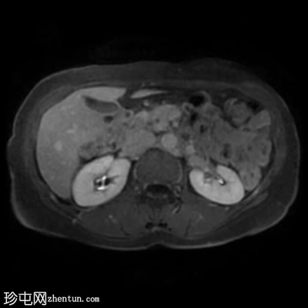 自身免疫性胰腺炎