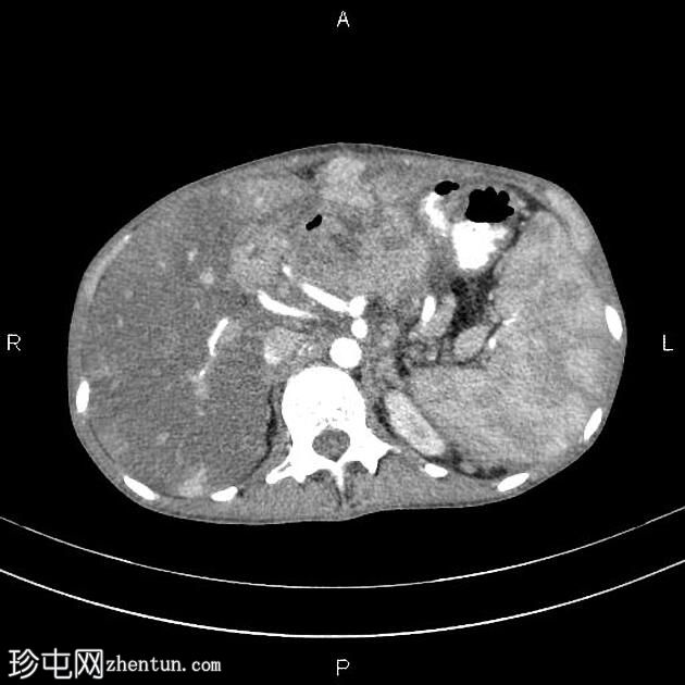 转移性胃肠道间质瘤