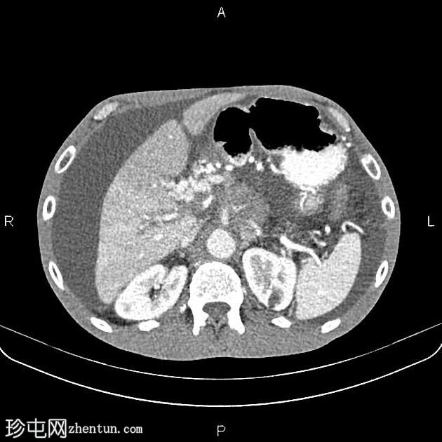 转移性胰腺导管腺癌