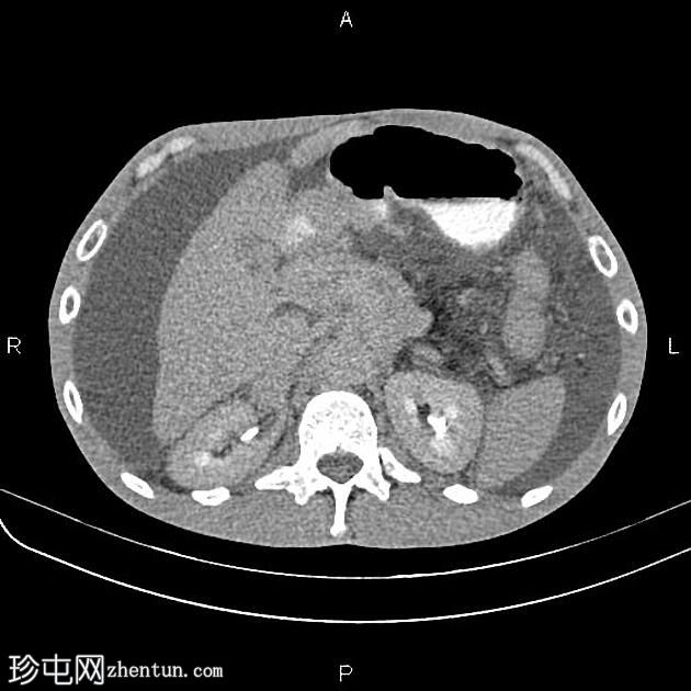 转移性胰腺导管腺癌