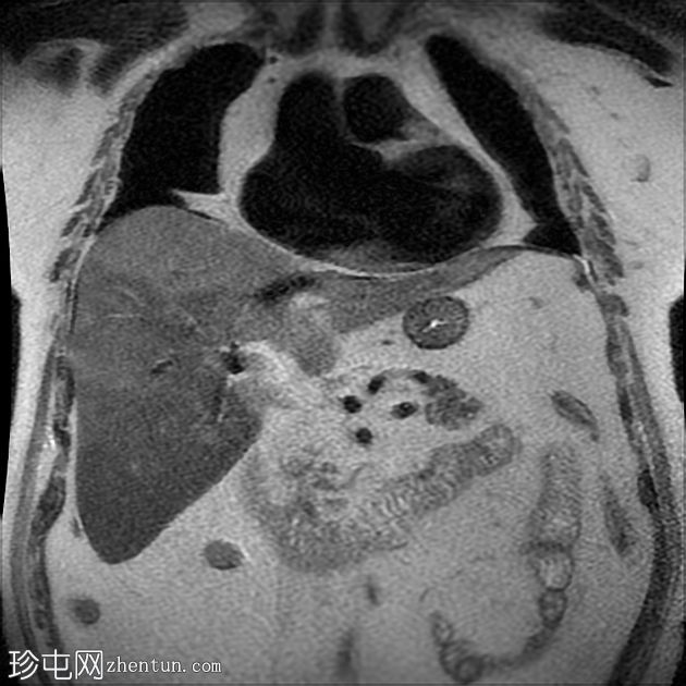 结节性和地域性肝脏脂肪变性