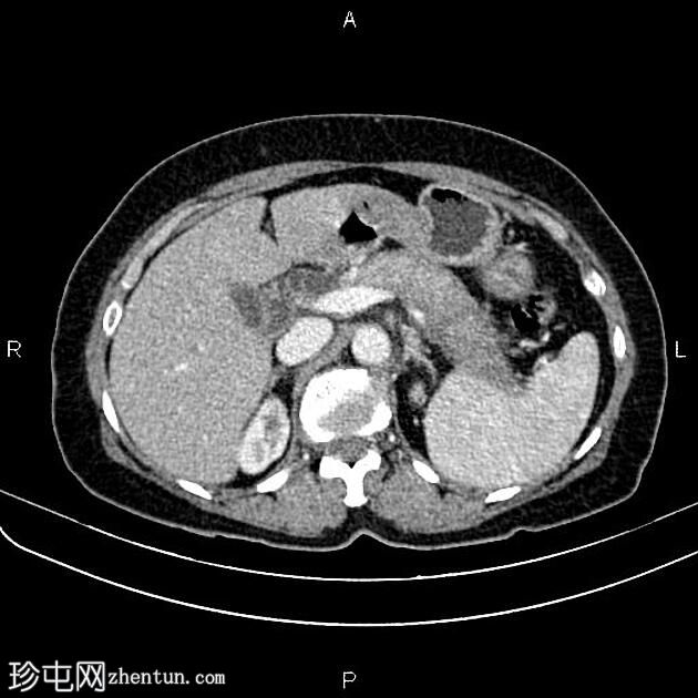 急性间质水肿性胰腺炎