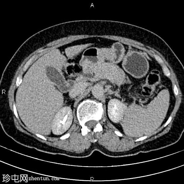 急性间质水肿性胰腺炎