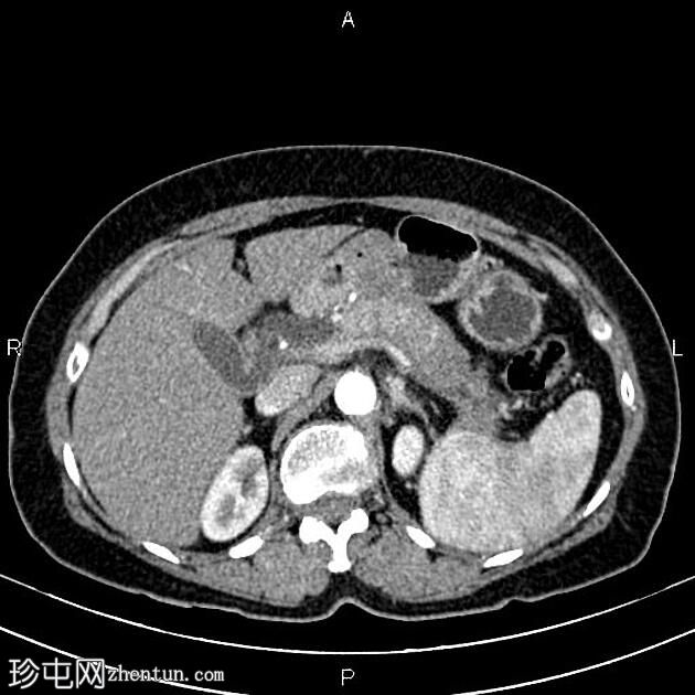 急性间质水肿性胰腺炎