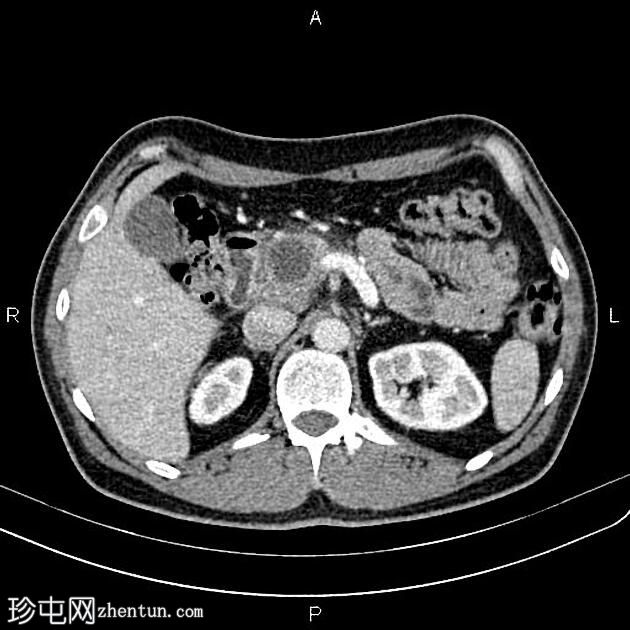 慢性胰腺炎伴假性囊肿