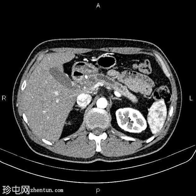 慢性胰腺炎伴假性囊肿