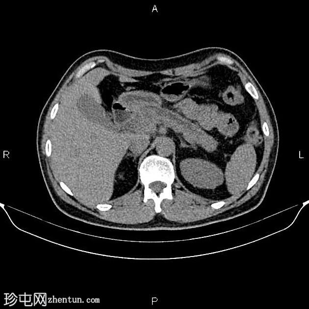 慢性胰腺炎伴假性囊肿