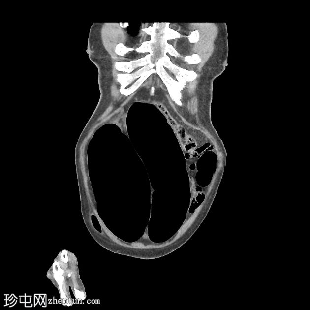 乙状结肠肠扭结