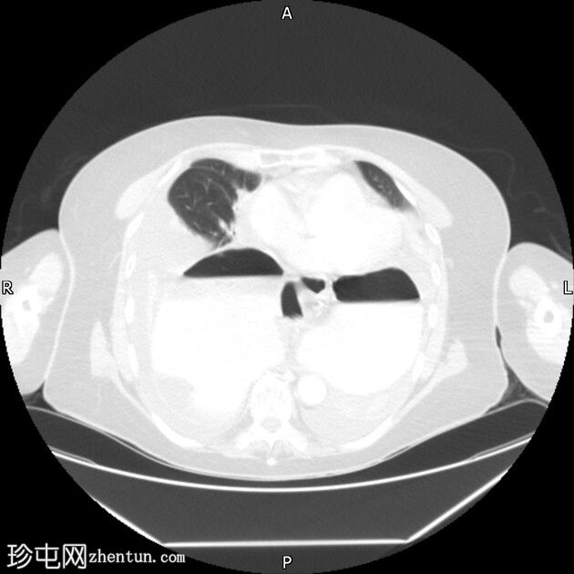 食管裂孔疝伴胃扭转