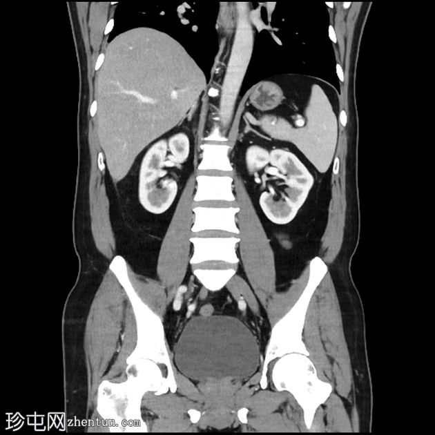 急性胆囊炎伴张性胆底征