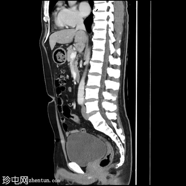 急性胆囊炎伴张性胆底征