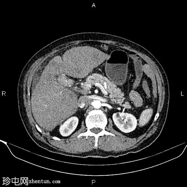 转移性胆囊腺癌