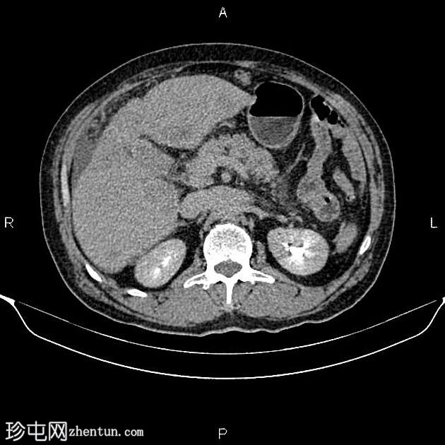 转移性胆囊腺癌