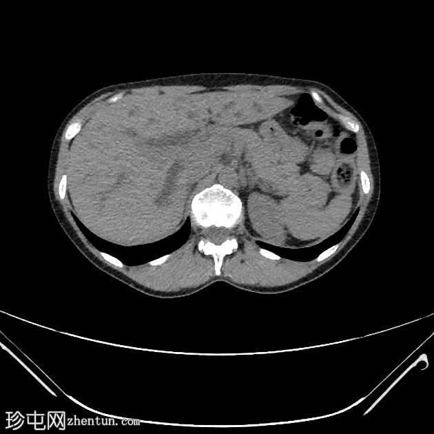 肝门周围胆管癌