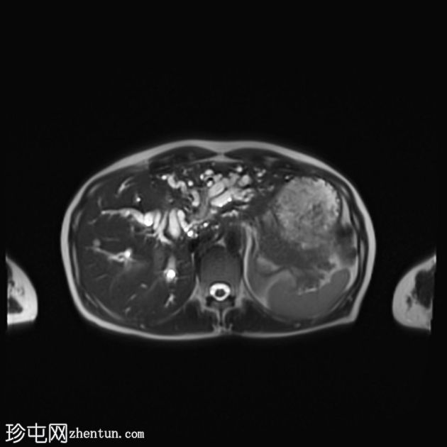 肝门周围胆管癌