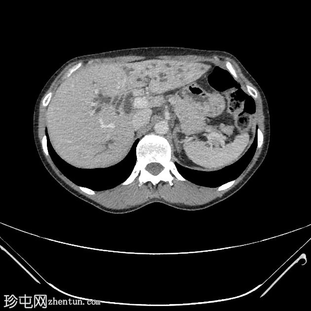 肝门周围胆管癌