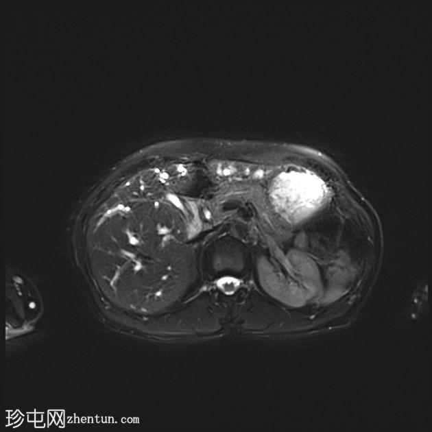 肝门周围胆管癌