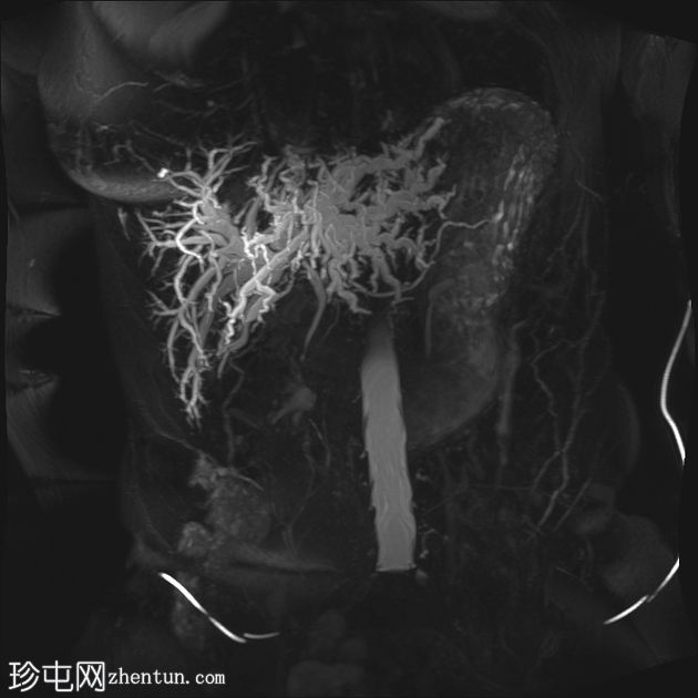 肝门周围胆管癌