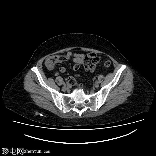 门静脉系统血栓形成