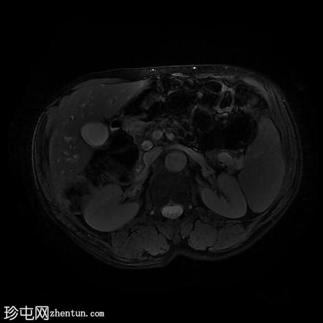 胆总管结石和胆石症 (MRCP)