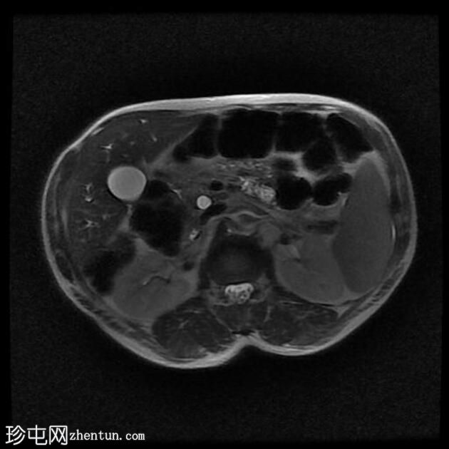 胆总管结石和胆石症 (MRCP)