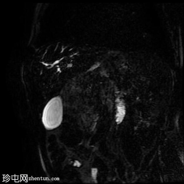 胆总管结石和胆石症 (MRCP)