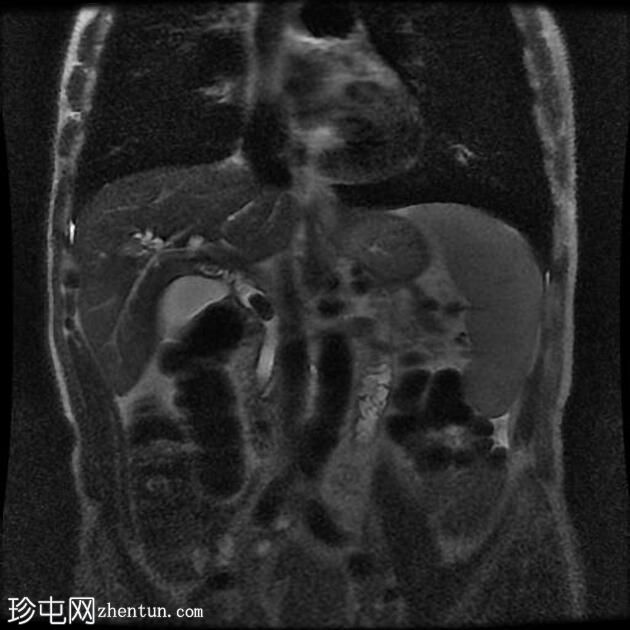 胆总管结石和胆石症 (MRCP)