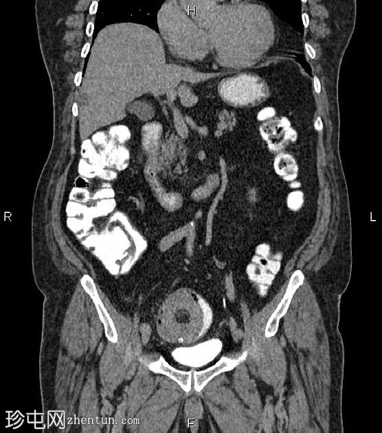肿瘤浸润引起的结肠套叠