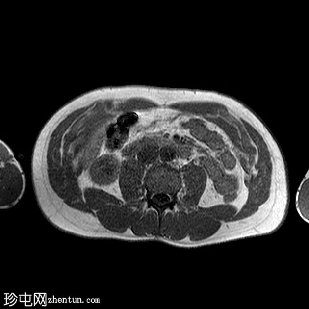 肝血管平滑肌脂肪瘤