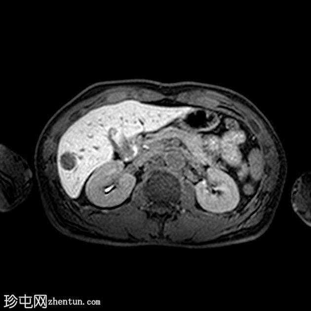 肝血管平滑肌脂肪瘤