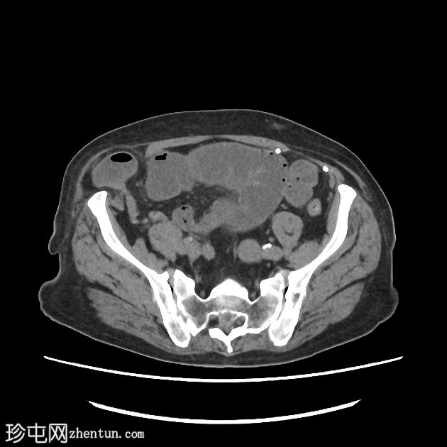 嵌顿性半月线疝