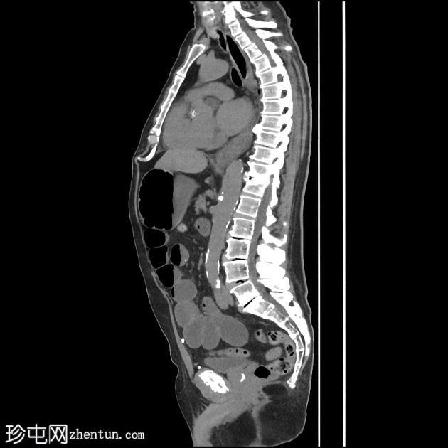 嵌顿性半月线疝