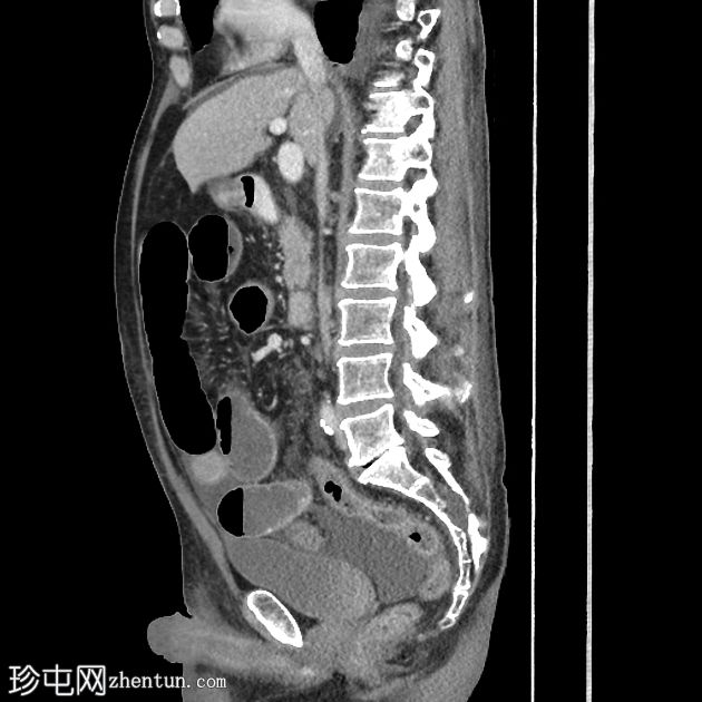 免疫治疗介导的结肠炎