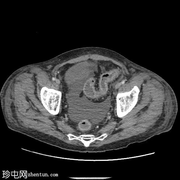 免疫治疗介导的结肠炎