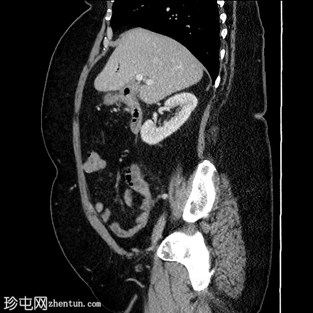 胆囊十二指肠瘘