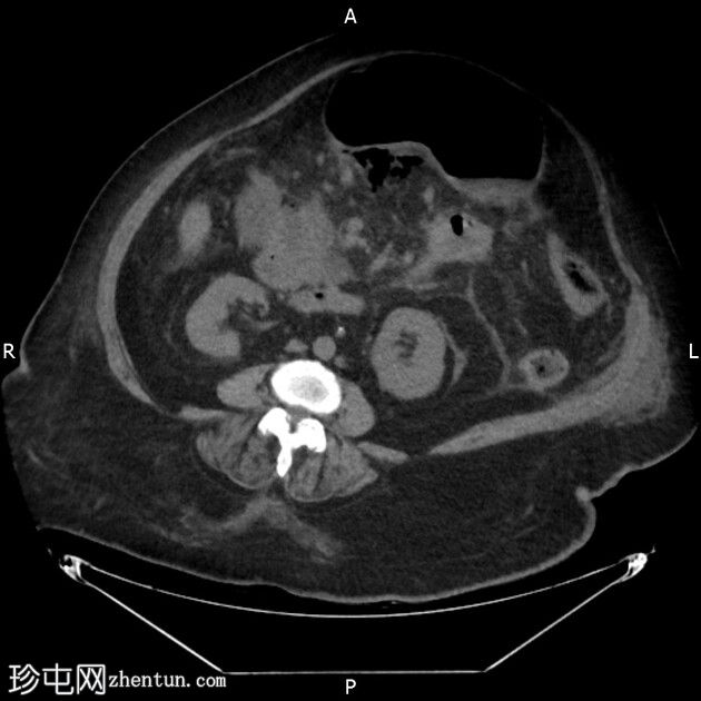 气肿性坏死性胰腺炎