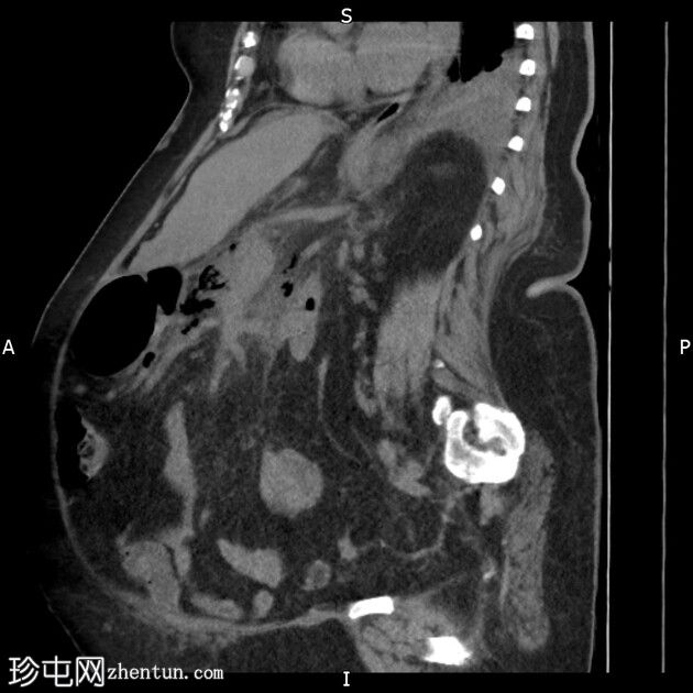 气肿性坏死性胰腺炎