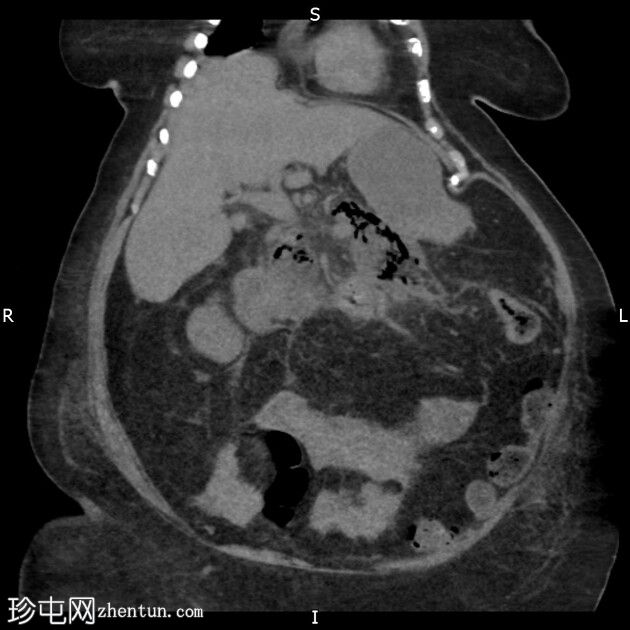 气肿性坏死性胰腺炎