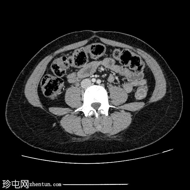 胆囊底折叠Phrygian cap（弗里吉亚帽）倒圆锥帽胆囊