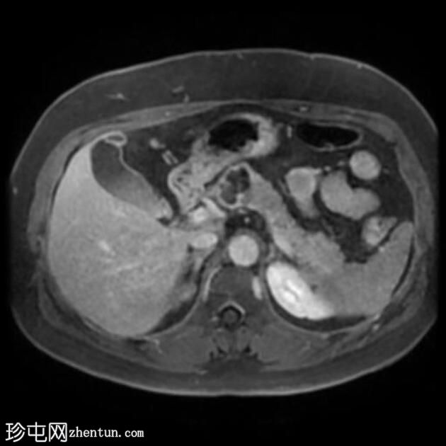 胰腺浆液性囊腺瘤