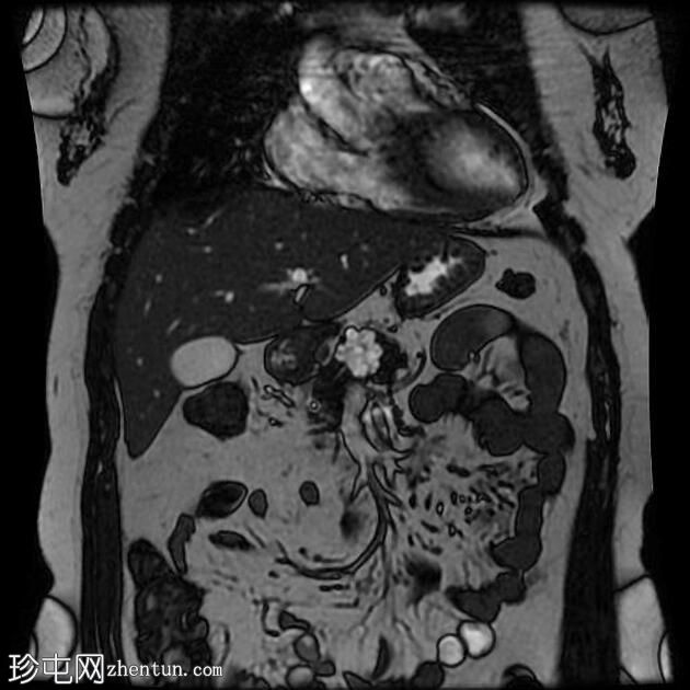 胰腺浆液性囊腺瘤