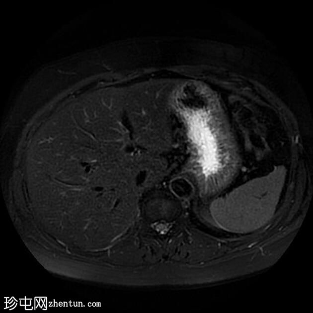 胰腺浆液性囊腺瘤