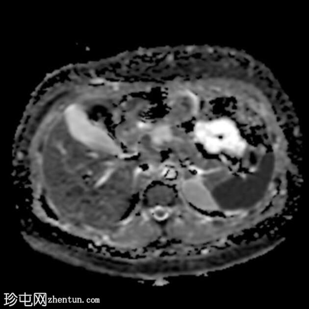 胰腺浆液性囊腺瘤