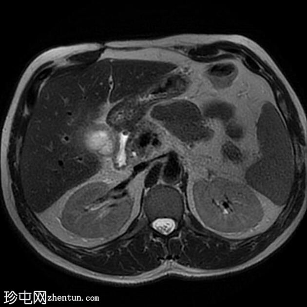 胆囊残余胆囊炎