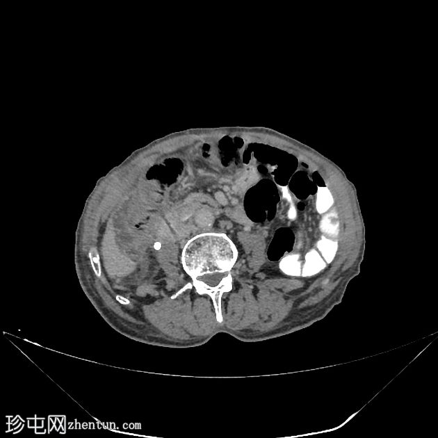 气肿性胆囊炎穿孔