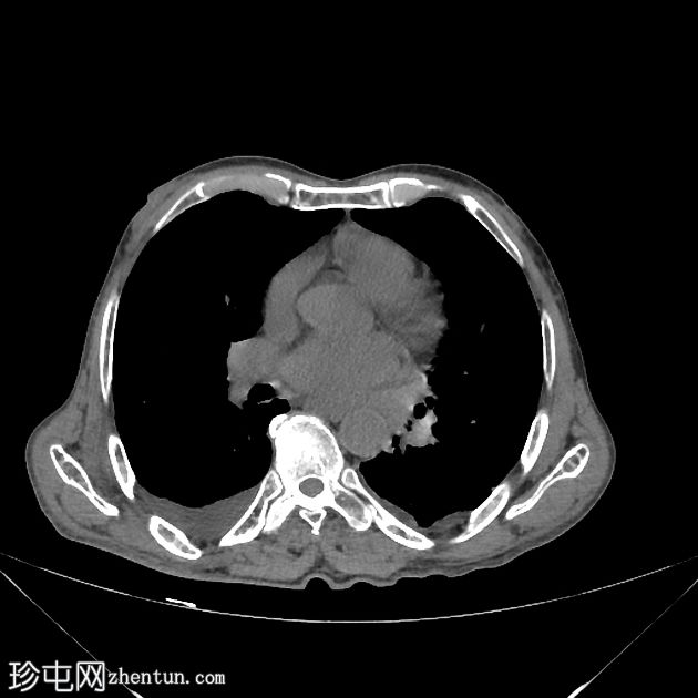 气肿性胆囊炎穿孔