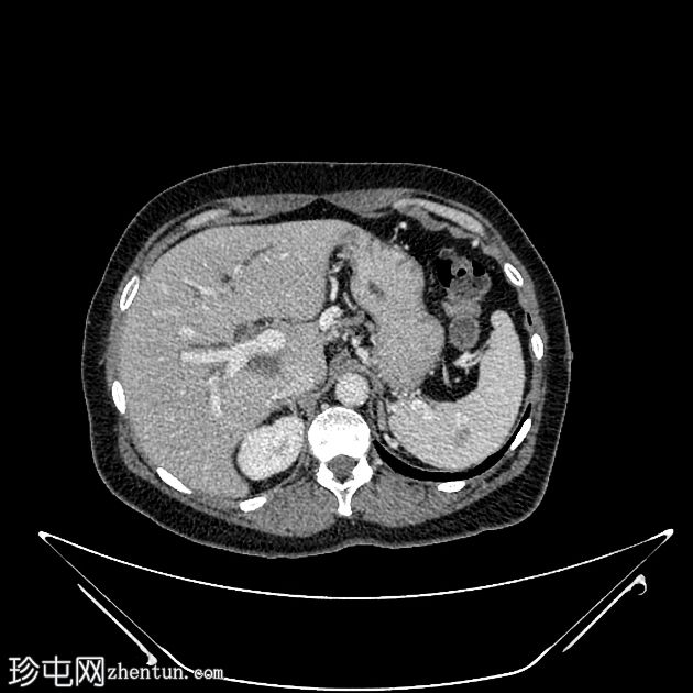 胰腺癌引起的双管征