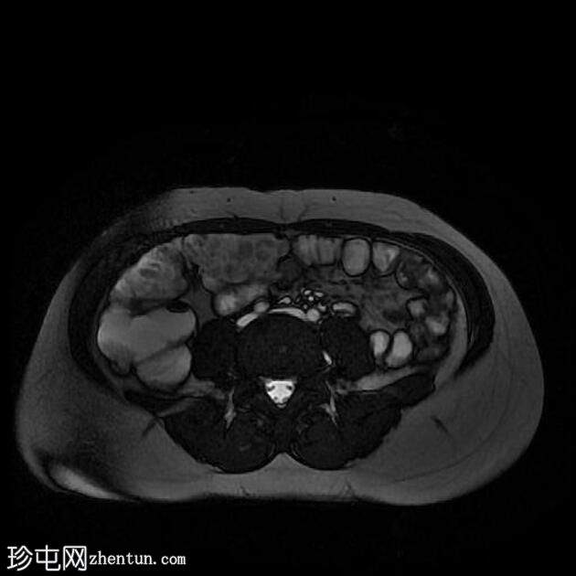 克罗恩病