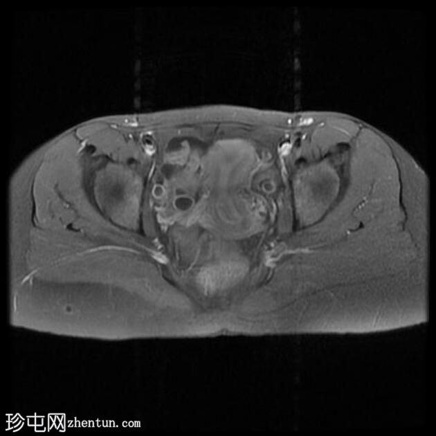 克罗恩病